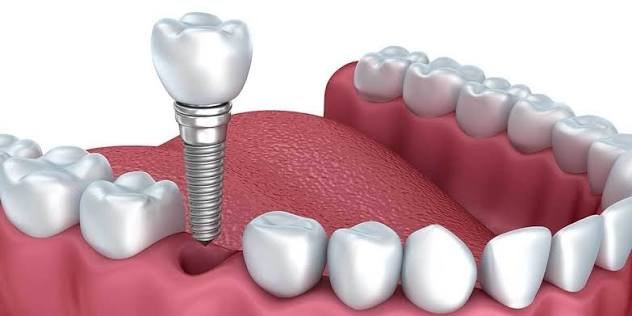 Dental implant placement procedure