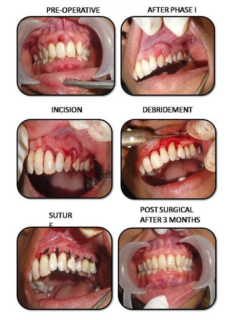 Periodontal gum surgery procedure