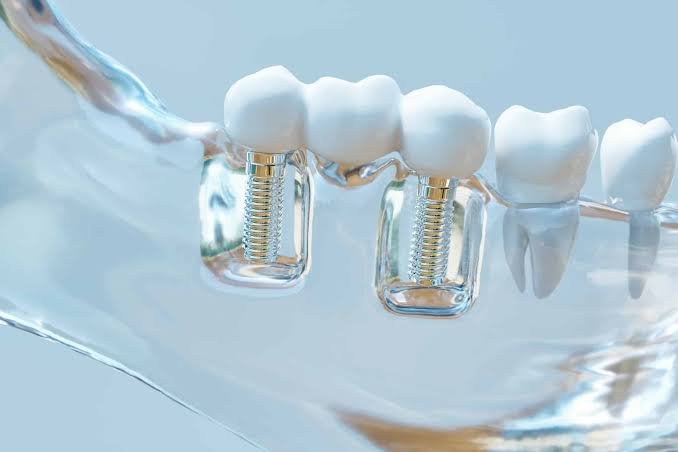Prosthetic dental crown and bridge rehabilitation