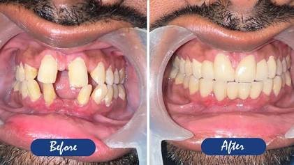 Cosmetic smile design consultation